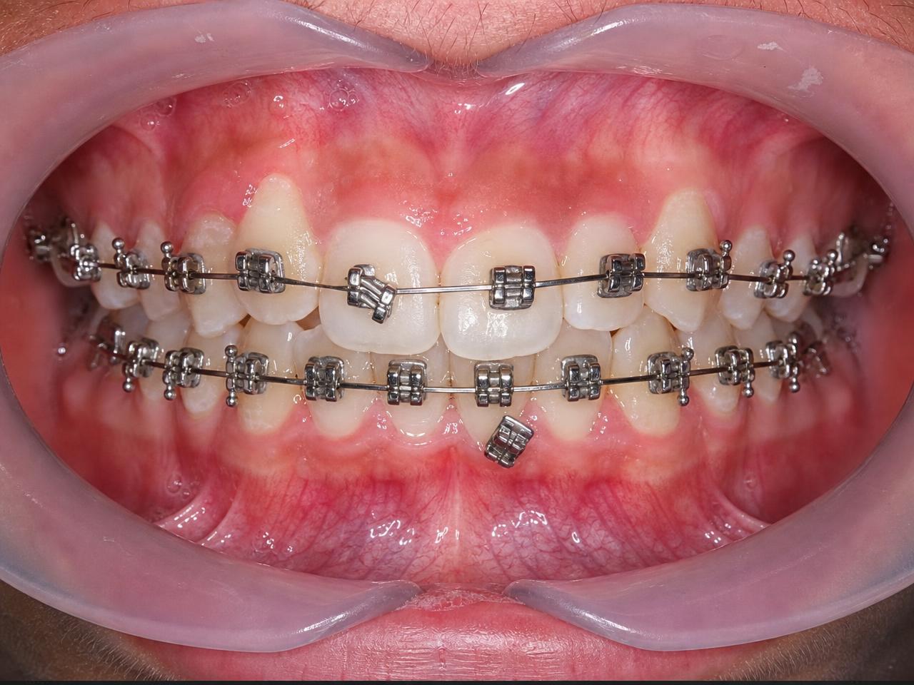 Dental model with braces showing a loose bracket on the archwire