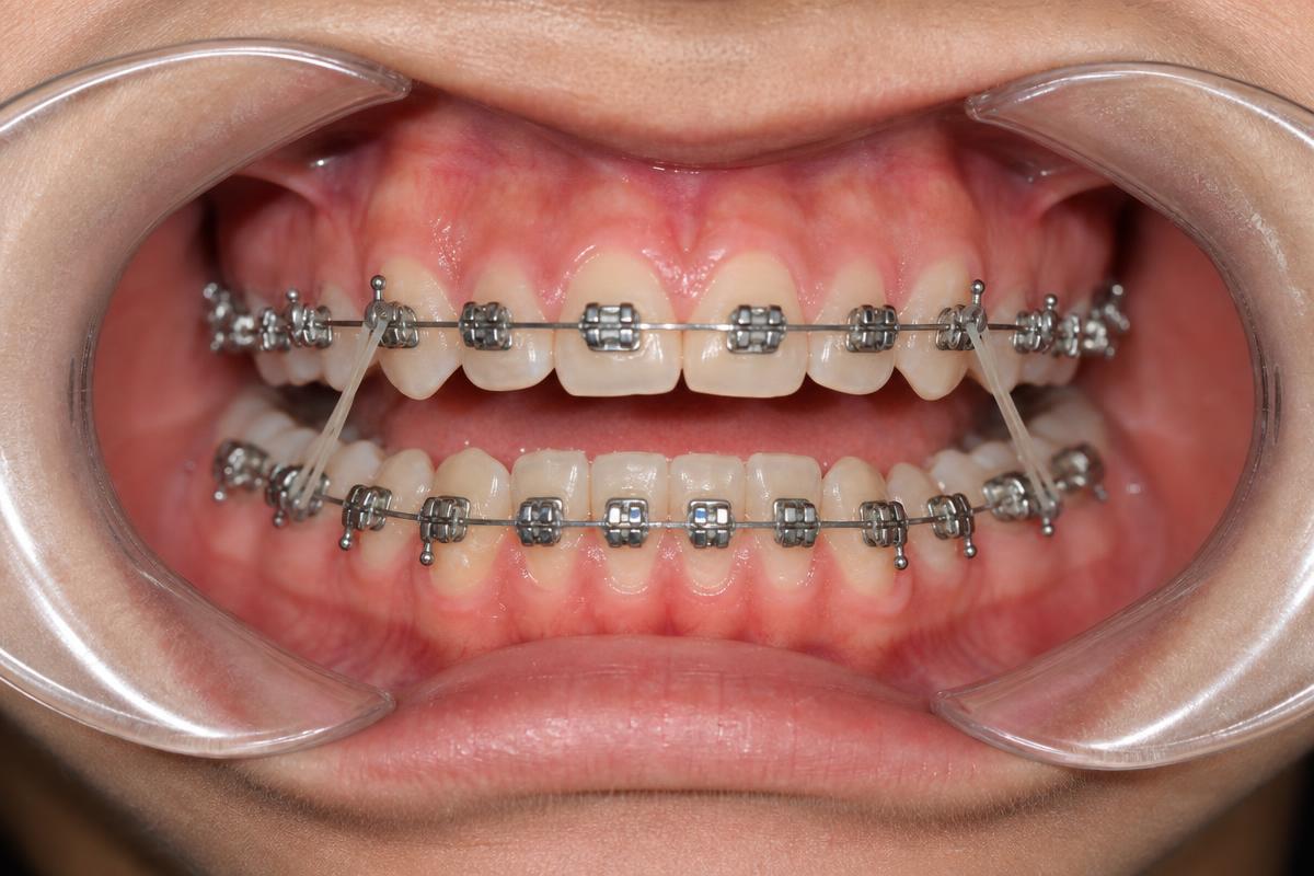 Orthodontic elastics hooked between upper and lower braces on a dental model