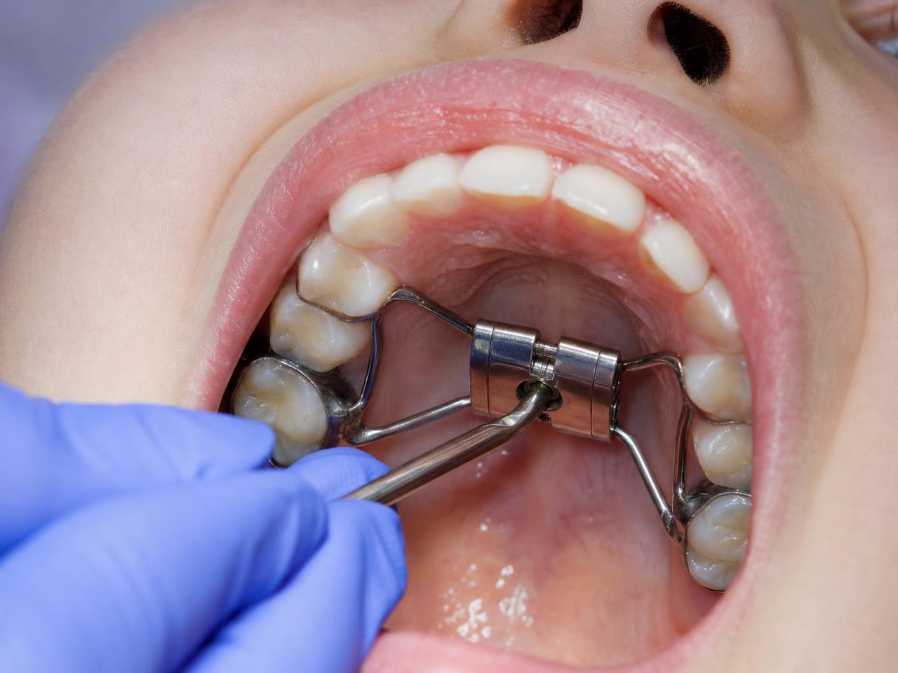 Parent holding an orthodontic expander key beside a palatal expander model